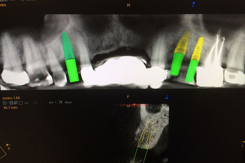 Laser Dentistry in 