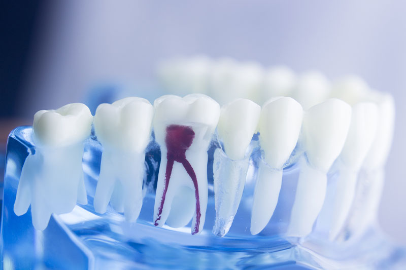 Root Canal in Fort Worth