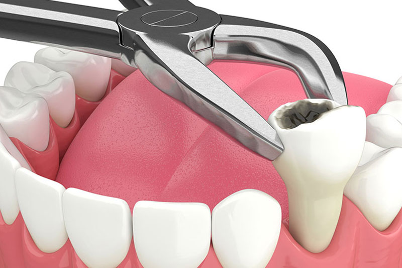Tooth Extraction in Wilmington