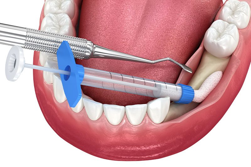 Bone Grafting in West Bloomfield