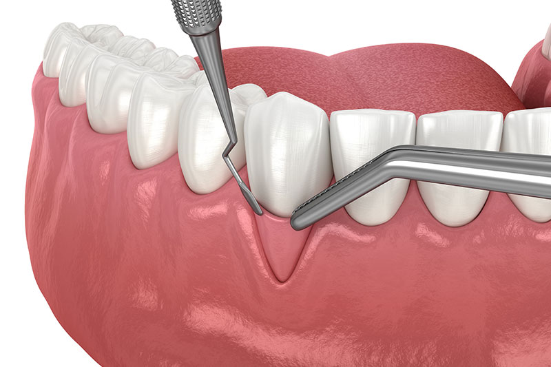 Minimally Invasive Gingival Grafting in West Bloomfield