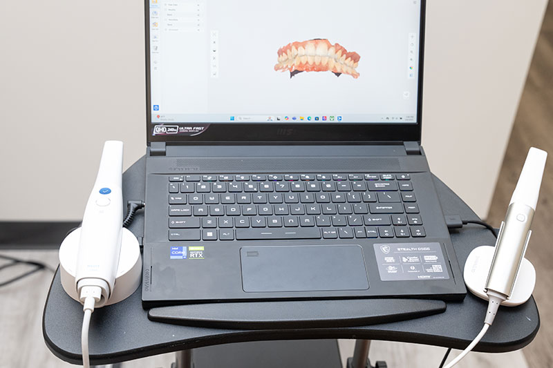 Intra-Oral Scanner in 