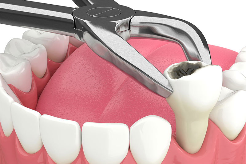 Single Tooth Extraction in Montville