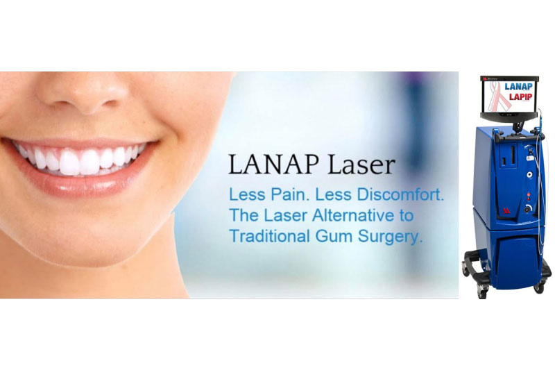 LANAP (Laser Gum Treatment) in Mt Pleasant