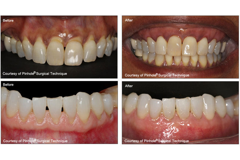 Chao Pinhole® Surgical Technique in Mt Pleasant