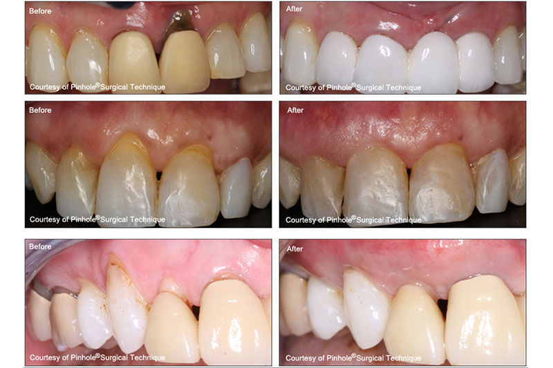 Chao Pinhole® Surgical Technique in Mt Pleasant