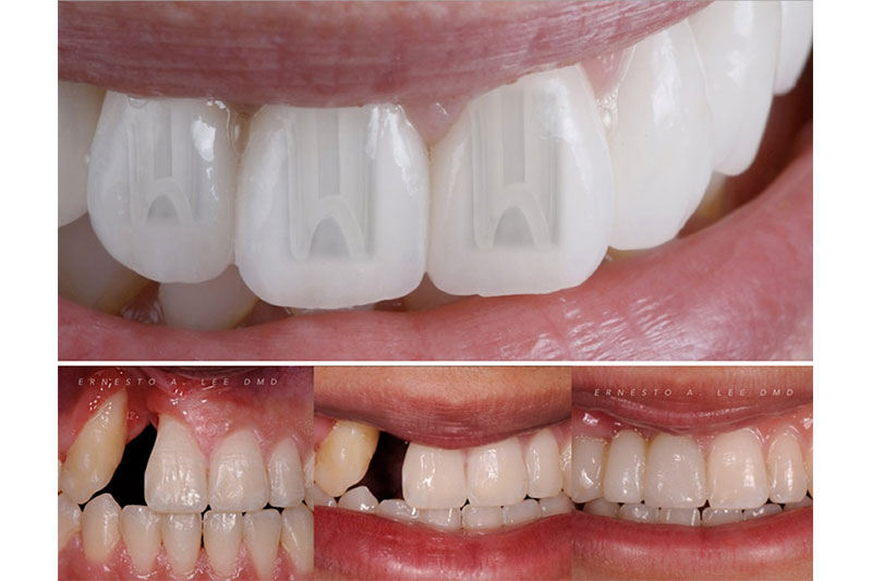 Bone Grafts in Mt Pleasant