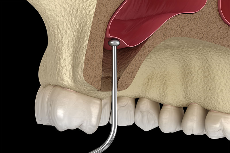 Sinus Augmentation in Kennewick