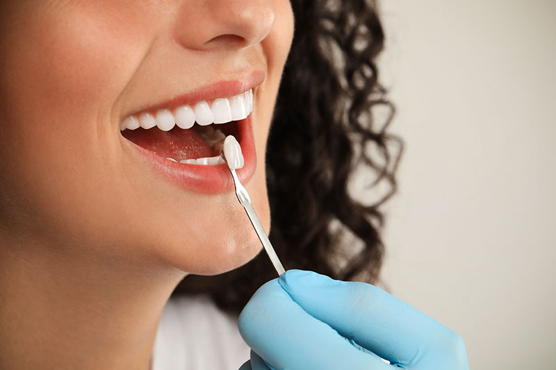 Dental Veneers in Torrance