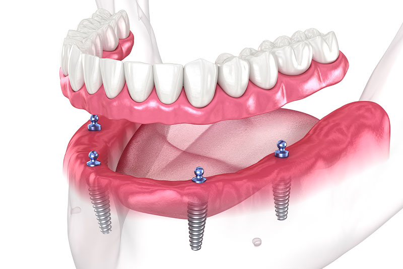 Dental Treatments in Slidell
