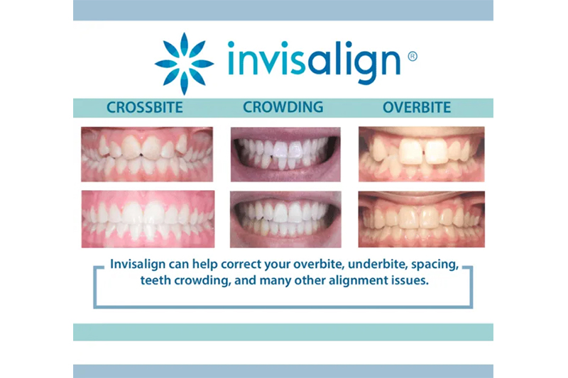 Invisalign in Milford