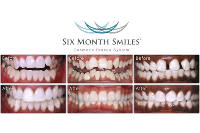 Six Month Smiles Clear Aligners in Trumbull