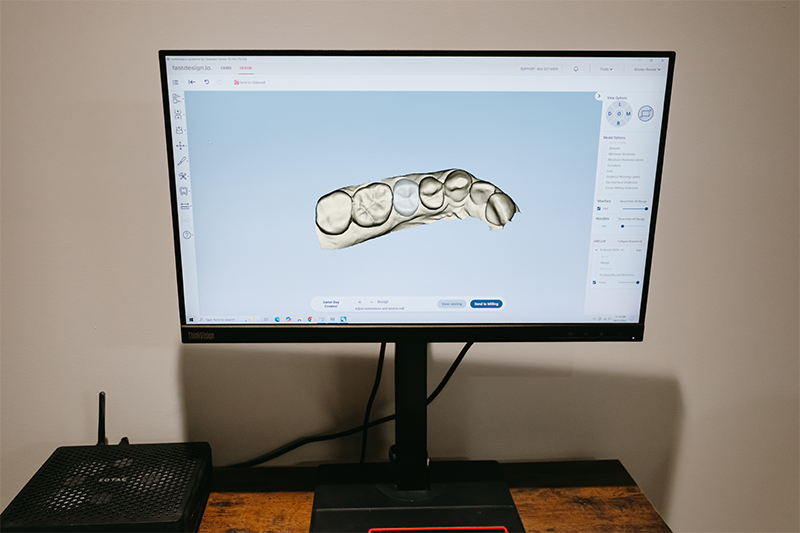 Intra-Oral Scanner in Eden