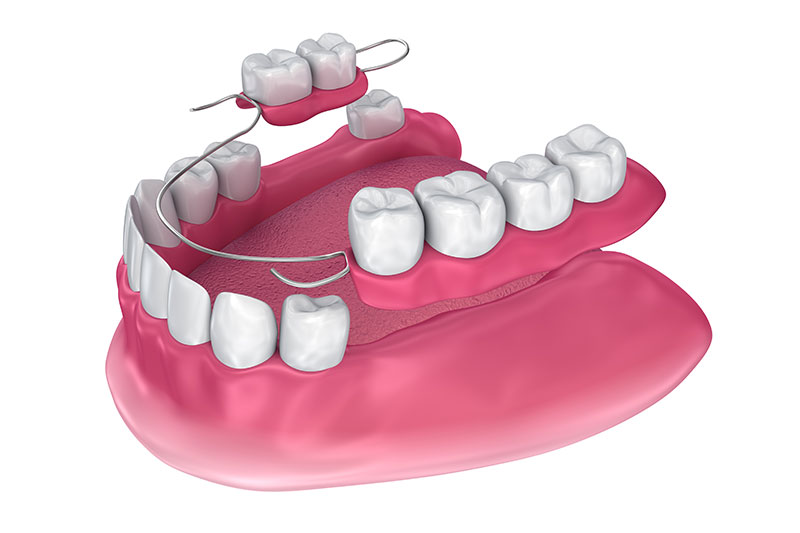 Partial Dentures in Dracut