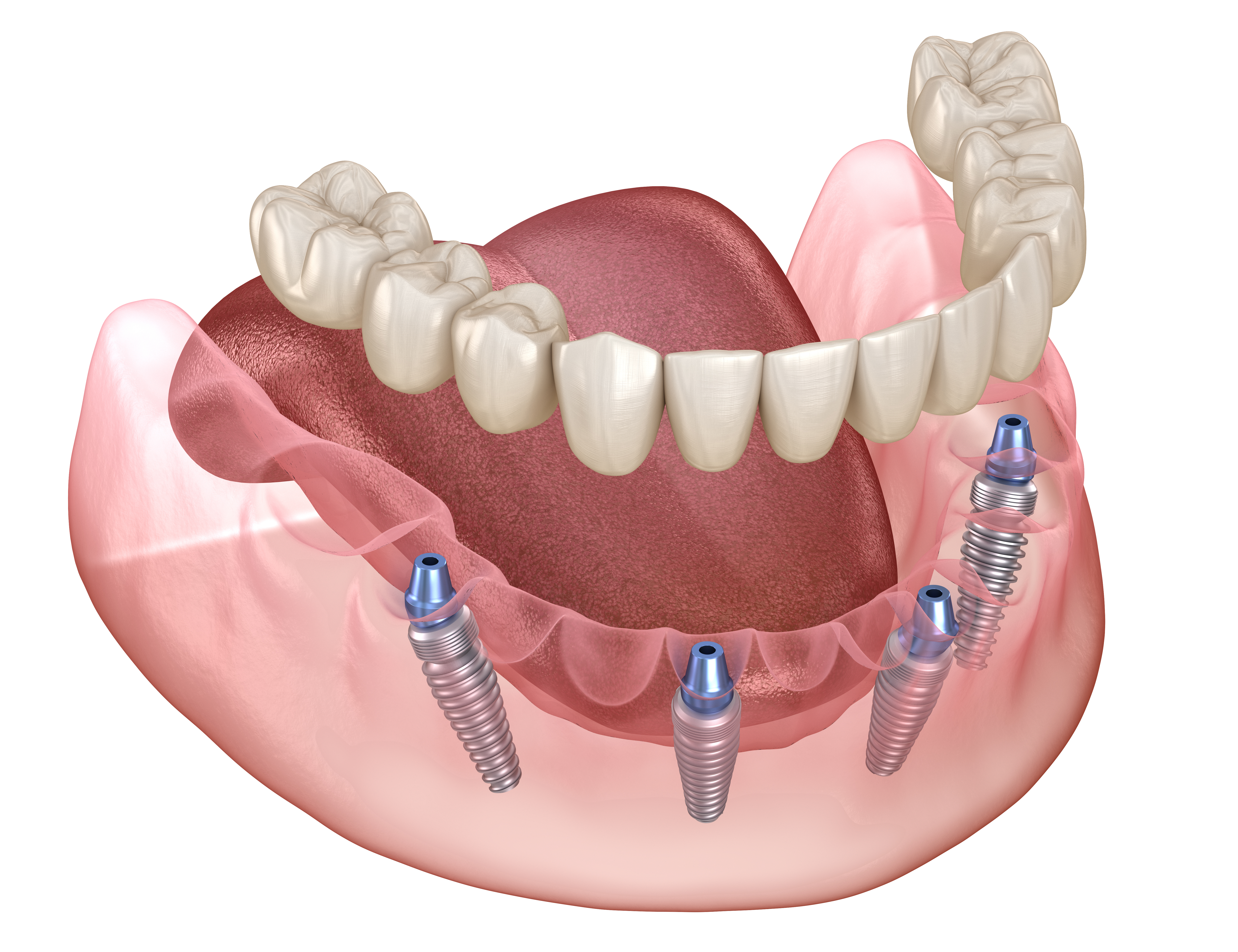 All on 4 Dental Implants in Pembroke Pines