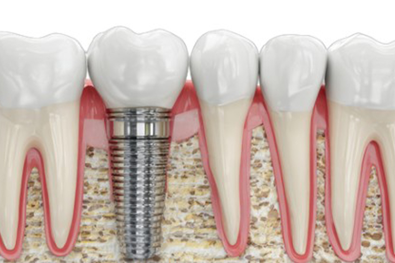 Dental Implants in Hartford