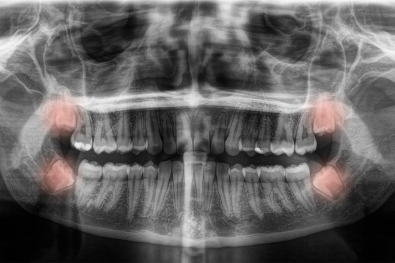 Tooth Extractions in Hartford