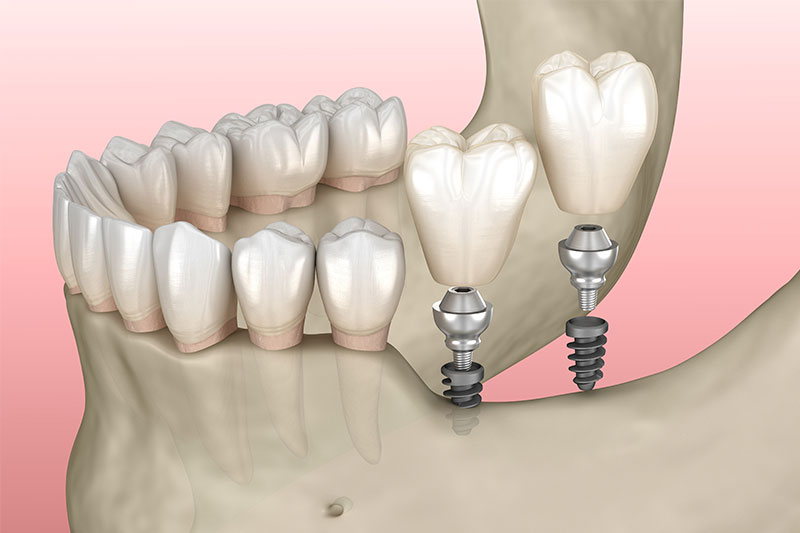 Multiple Dental Implants in Hartford
