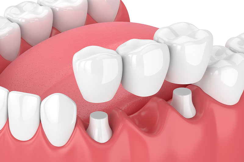 Dental Bridges in Apex
