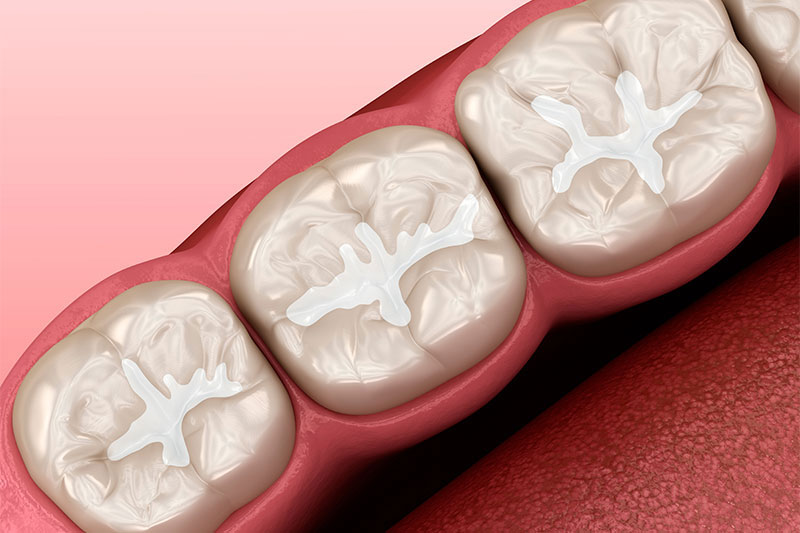 Dental Sealants in Cedar Park