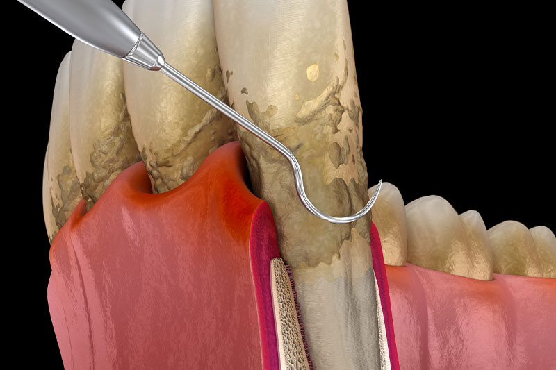 Gum Disease / Periodontal Treatment in Clarkston