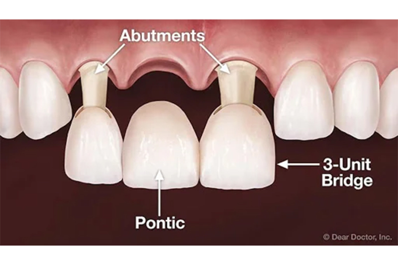 Bridges in Ridgeland
