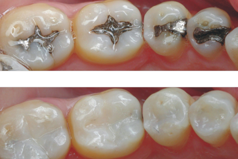 Composite Bonded Fillings in Ridgeland