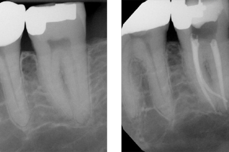 Root Canal Therapy in Ridgeland