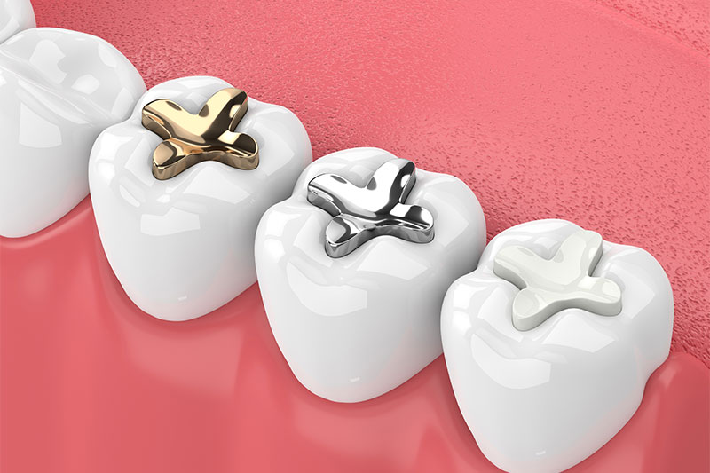Dental Fillings in Aubrey