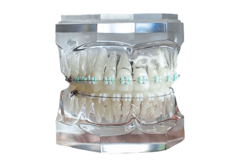 LightForce Custom 3D-Printed Braces in Wesley Chapel