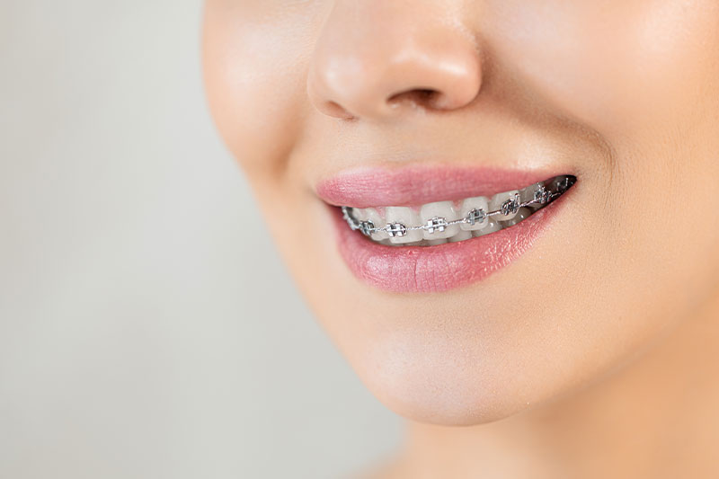 Braces in Wesley Chapel