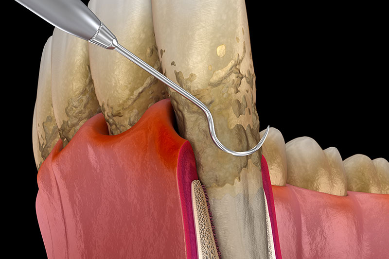 Periodontal Treatment in Indianapolis