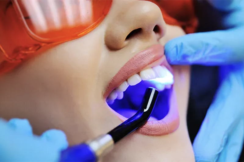 Dental Bonding in Wilsonville