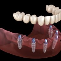 Full Arch in Chicopee