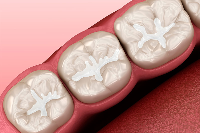 Dental Sealants in River Forest