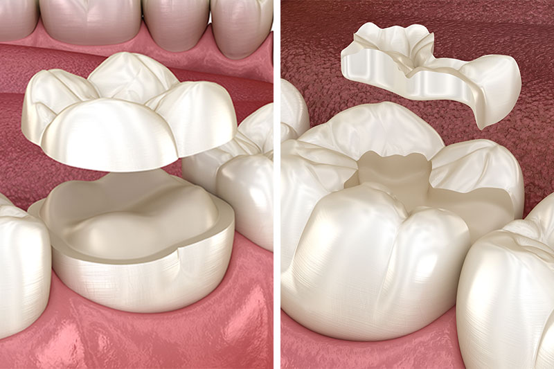 Dental Inlays and Onlays in Newaygo