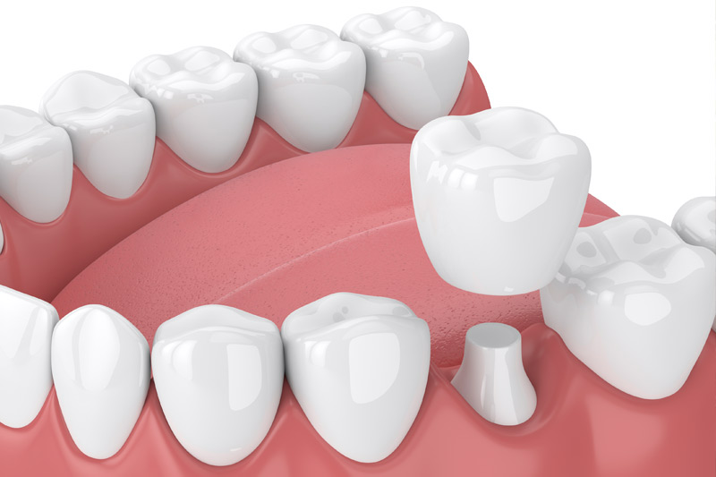 Dental Crowns in Charlotte