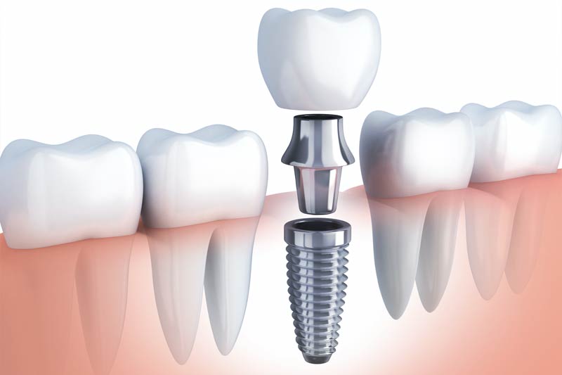 Dental Implants in Charlotte