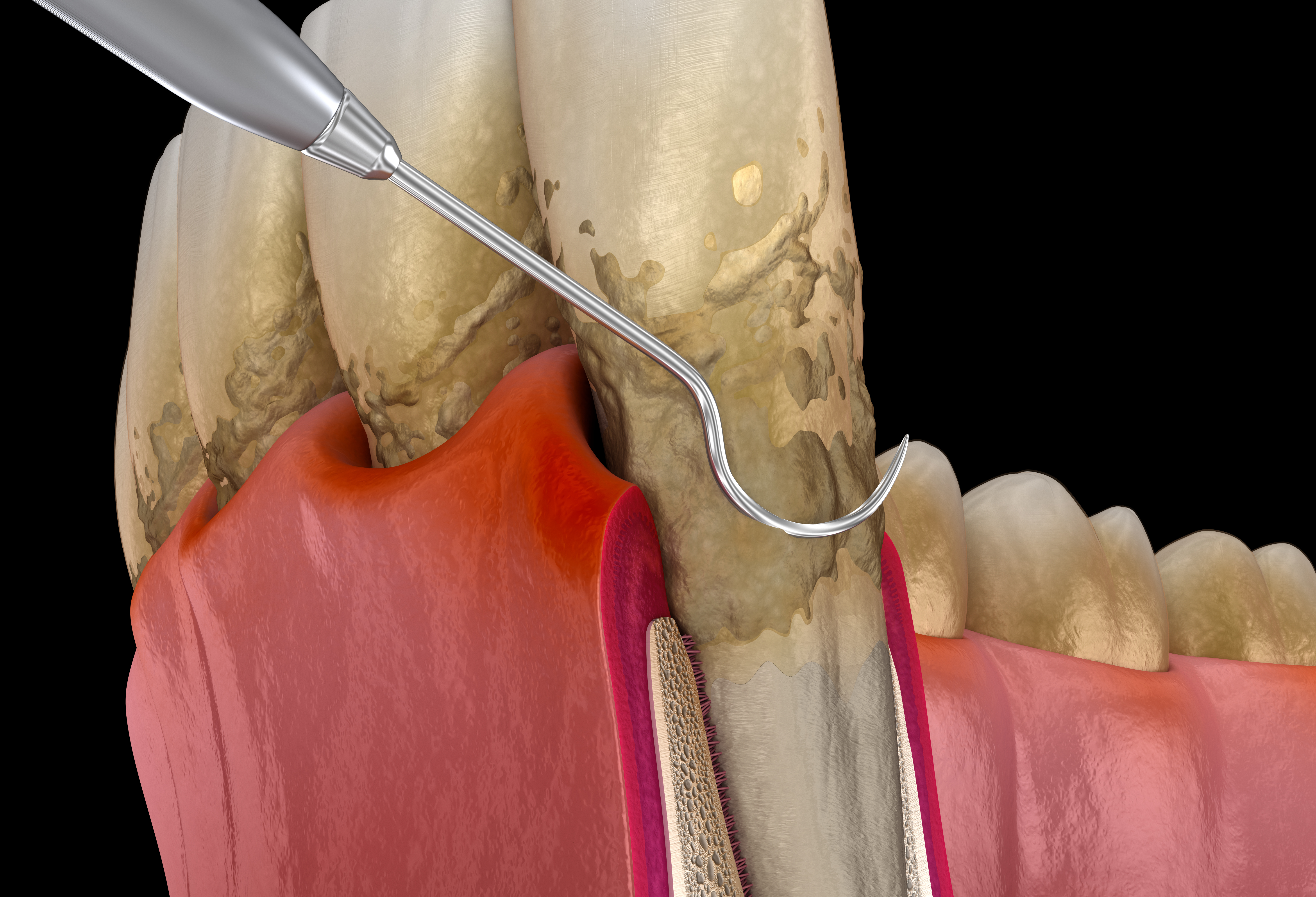Gum Disease / Periodontal Treatment in Baraboo