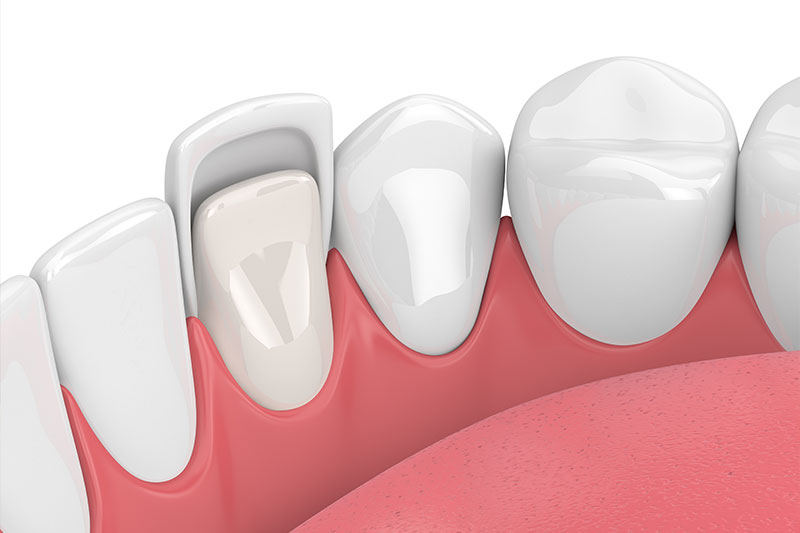 Porcelain Veneers in Pompton Plains