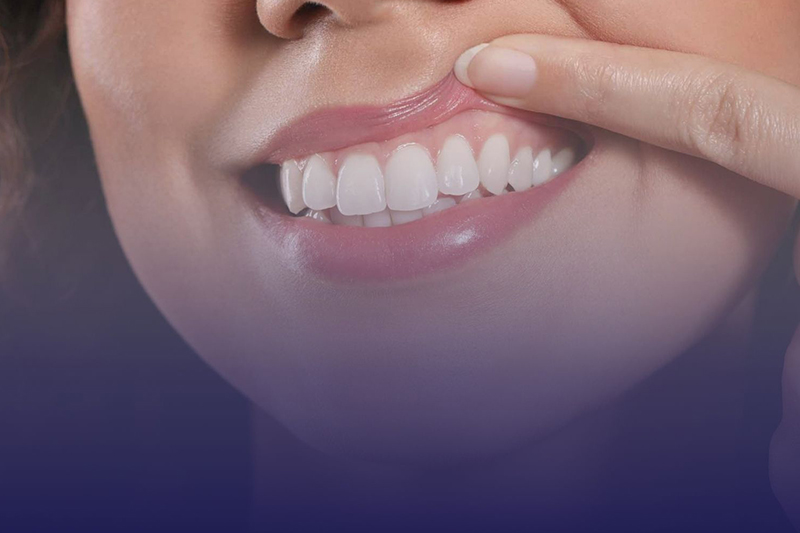 Soft Tissue Grafting in Tucson