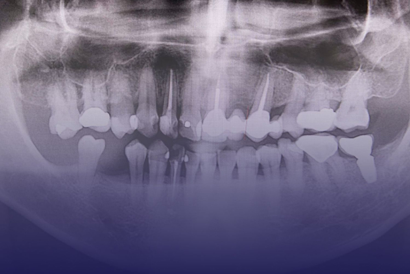 Bone Grafting in Tucson