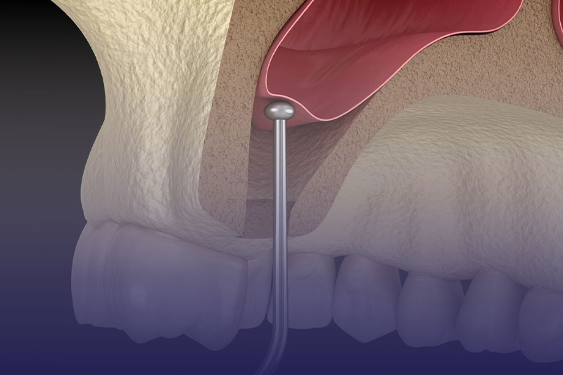 Sinus Augmentation in Tucson
