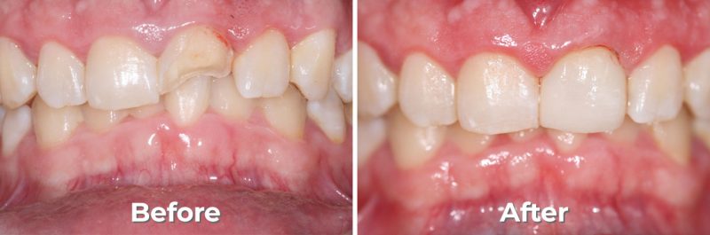 Cosmetic Bonding in West Grove