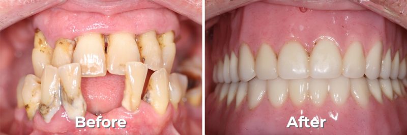 Removable Partials & Dentures in West Grove