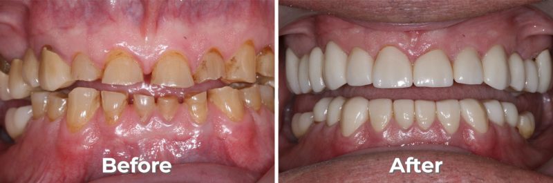 Full Mouth Reconstruction in West Grove