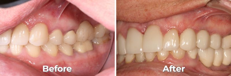 Implants Dentist in West Grove