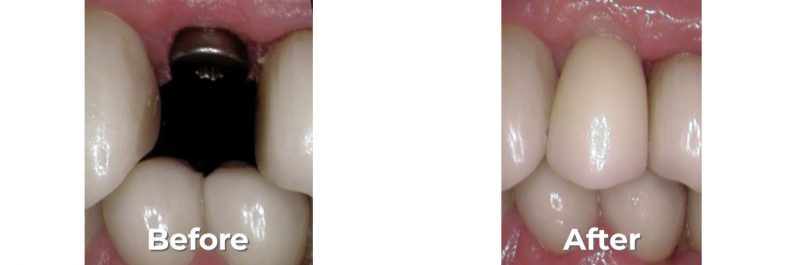 Implants Dentist in West Grove