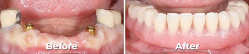 Implants Dentist in West Grove