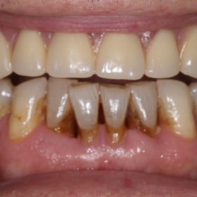 Implants Dentist in West Grove